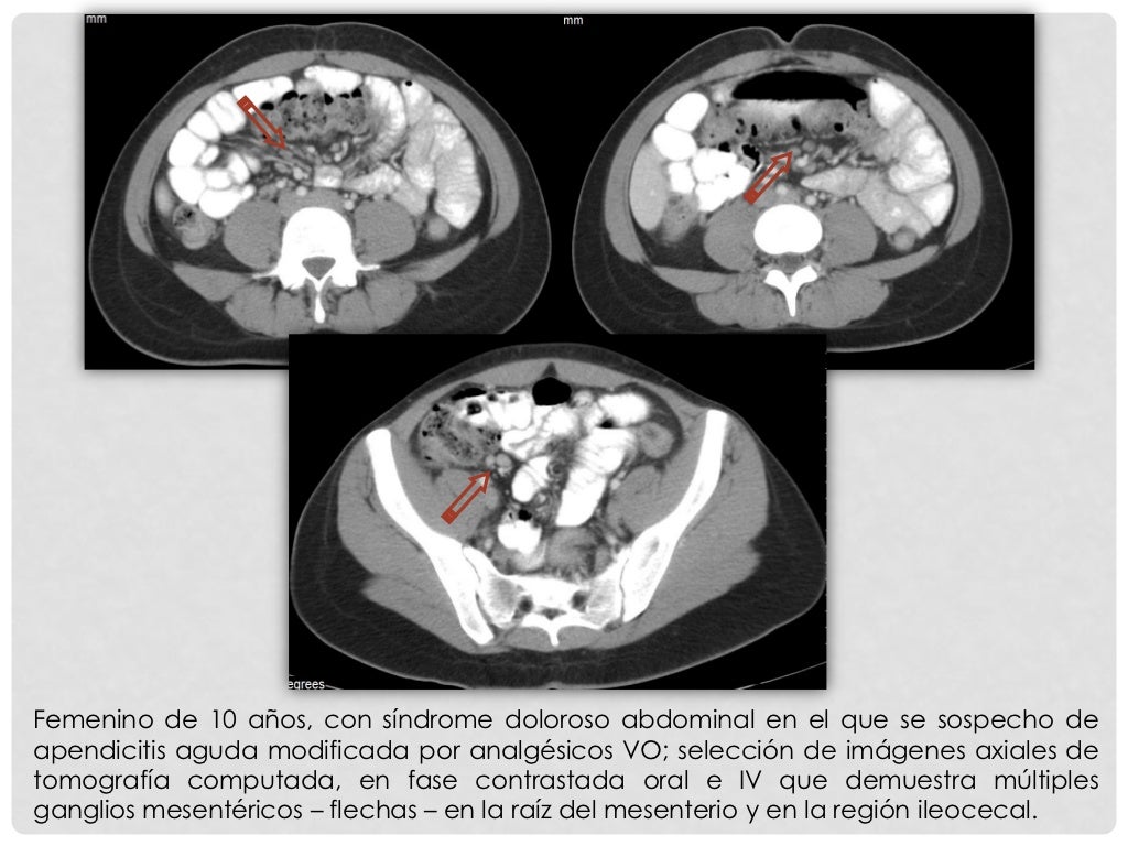 Adenitis mesenterica Adenitis mesenterica