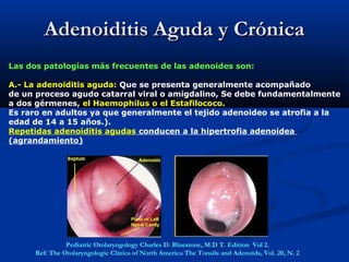 Adenoiditis Aguda y CrónicaAdenoiditis Aguda y Crónica
Las dos patologías más frecuentes de las adenoides son:
A.- La adenoiditis aguda: Que se presenta generalmente acompañado
de un proceso agudo catarral viral o amigdalino, Se debe fundamentalmente
a dos gérmenes, el Haemophilus o el Estafilococo.
Es raro en adultos ya que generalmente el tejido adenoideo se atrofia a la
edad de 14 a 15 años.).
Repetidas adenoiditis agudas conducen a la hipertrofia adenoidea
(agrandamiento)
Pediatric Otolaryngology Charles D. Bluestone, M.D T. Edition Vol 2.
Ref: The Otolaryngologic Clinics of North America The Tonsils and Adenoids, Vol. 20, N. 2
 