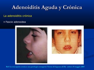 Adenoiditis Aguda y CrónicaAdenoiditis Aguda y Crónica
La adenoiditis crónica
• Fascie adenoidea
Ref: La roncopatia cronica: una patologia emergente Terme di Lignano (UD)  sabato 15 maggio 2004
 