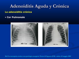 Adenoiditis Aguda y CrónicaAdenoiditis Aguda y Crónica
La adenoiditis crónica
• Cor Pulmonale
Ref: La roncopatia cronica: una patologia emergente Terme di Lignano (UD)  sabato 15 maggio 2004
 