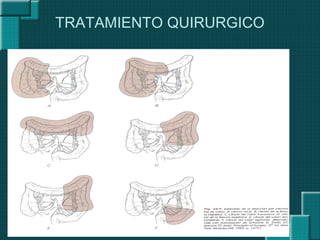 TRATAMIENTO QUIRURGICO
 