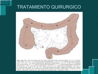 TRATAMIENTO QUIRURGICO
 