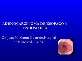 ADENOCARCINOMA DE ESOFAGO Y
        ENDOSCOPIA

Dr. Juan M. Martín Guerrero.Hospital
        de la Merced. Osuna.
 