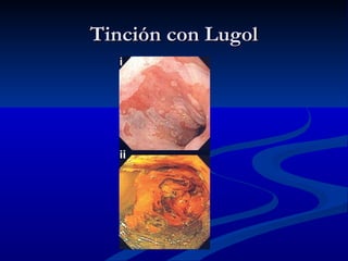 Tinción con Lugol
 