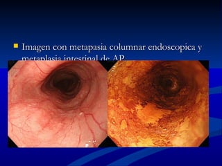    Imagen con metapasia columnar endoscopica y
    metaplasia intestinal de AP
 