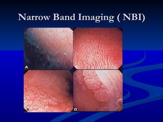 Narrow Band Imaging ( NBI)
 