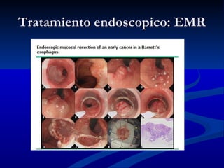 Tratamiento endoscopico: EMR
 