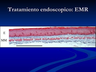 Tratamiento endoscopico: EMR
 