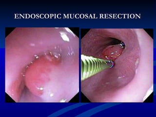 ENDOSCOPIC MUCOSAL RESECTION
 