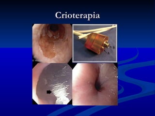 Crioterapia
 