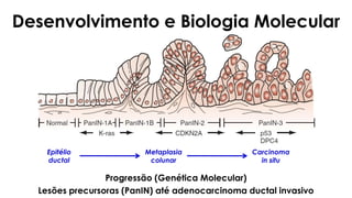 Desenvolvimento e Biologia Molecular
Progressão (Genética Molecular)
Lesões precursoras (PanIN) até adenocarcinoma ductal invasivo
Epitélio
ductal
Metaplasia
colunar
Carcinoma
in situ
 