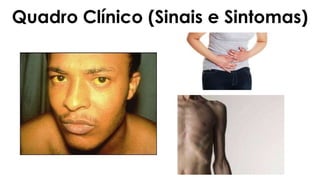 Quadro Clínico (Sinais e Sintomas)
 