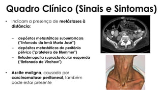 • Indicam a presença de metástases à
distância:
– depósitos metastáticos subumbilicais
("linfonodo da irmã Maria José”)
– depósitos metastáticos do peritônio
pélvico ("prateleira de Blummer")
– linfadenopatia supraclavicular esquerda
(“linfonodo de Virchow")
• Ascite maligna, causada por
carcinomatose peritoneal, também
pode estar presente
Quadro Clínico (Sinais e Sintomas)
 