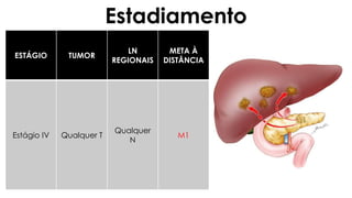 ESTÁGIO TUMOR
LN
REGIONAIS
META À
DISTÂNCIA
Estágio IV Qualquer T
Qualquer
N
M1
Estadiamento
 