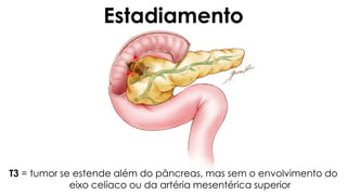 T3 = tumor se estende além do pâncreas, mas sem o envolvimento do
eixo celíaco ou da artéria mesentérica superior
Estadiamento
 