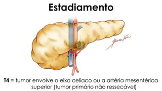 T4 = tumor envolve o eixo celíaco ou a artéria mesentérica
superior (tumor primário não ressecável)
Estadiamento
 