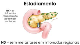 N0 = sem metástases em linfonodos regionais
NX = os
linfonodos
regionais não
podem ser
avaliados
Estadiamento
 