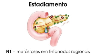 N1 = metástases em linfonodos regionais
Estadiamento
 