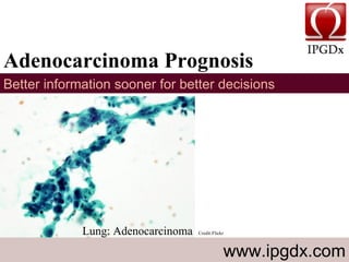 Adenocarcinoma Prognosis  www.ipgdx.com Better information sooner for better decisions Lung: Adenocarcinoma  Credit:Flickr 