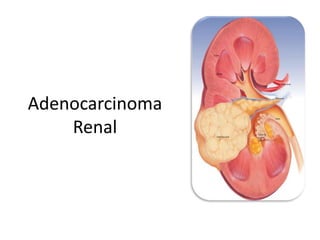 Adenocarcinoma
Renal
 