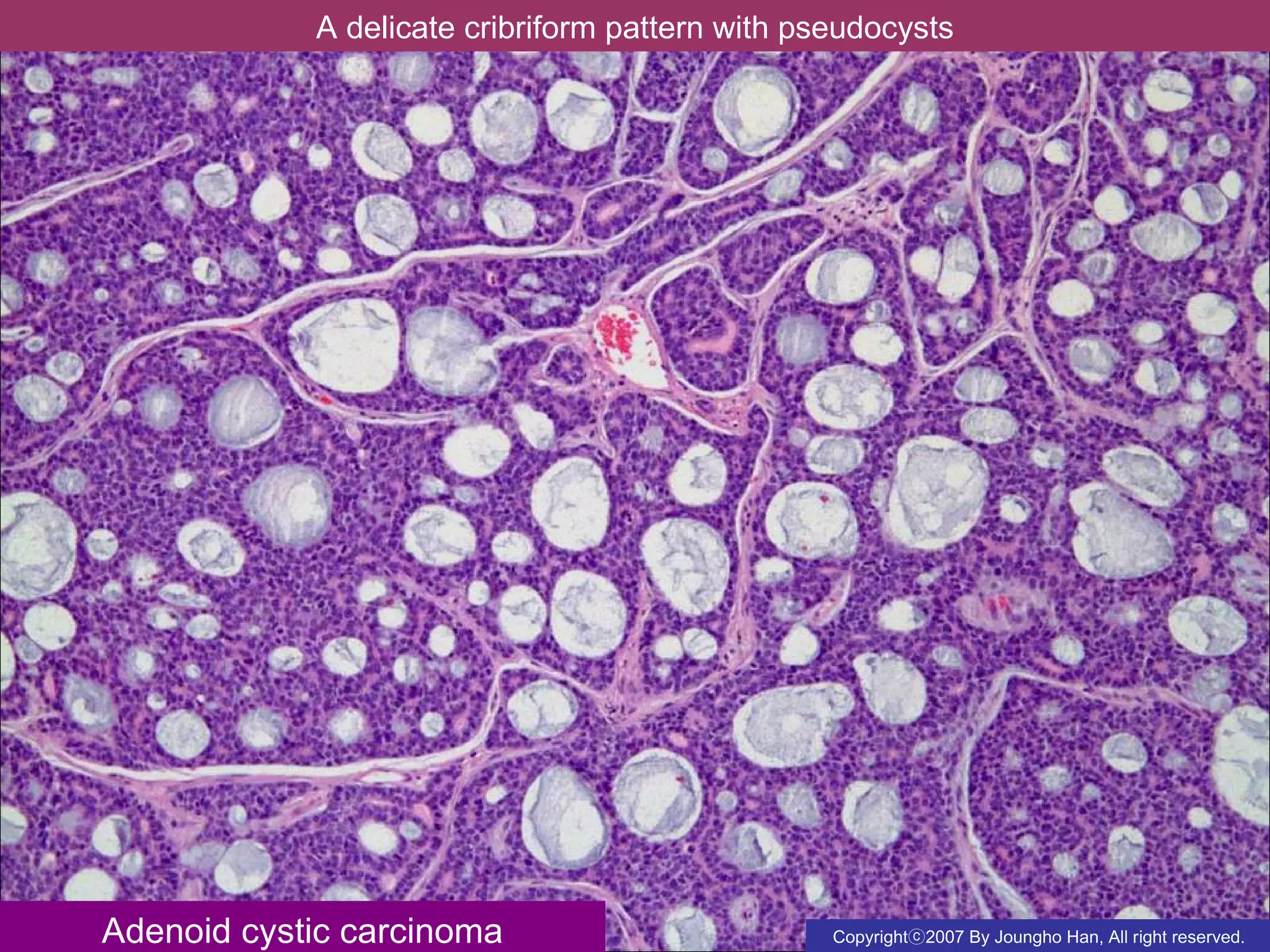Adenoid cystic carcinoma trachea | PPT