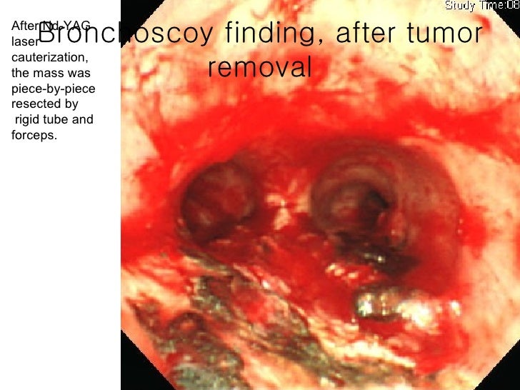 Adenoid cystic carcinoma trachea