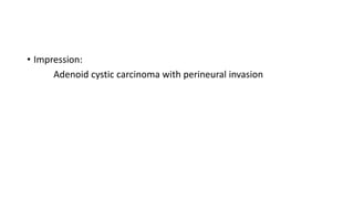• Impression:
Adenoid cystic carcinoma with perineural invasion
 