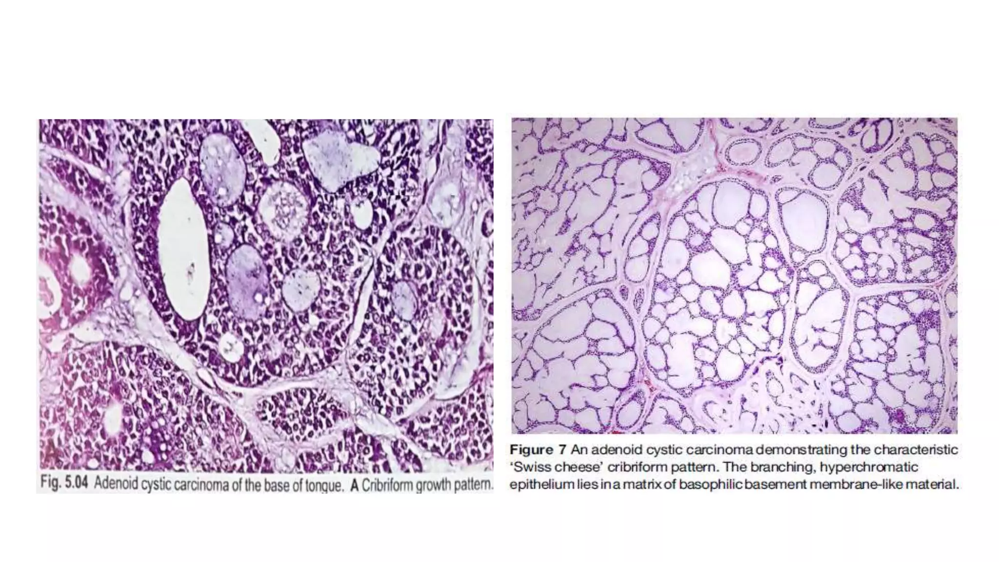 Adenoid cystic carcinoma (Doctor Faris Alabeedi MSc, MMedSc, PgDip, BDS ...