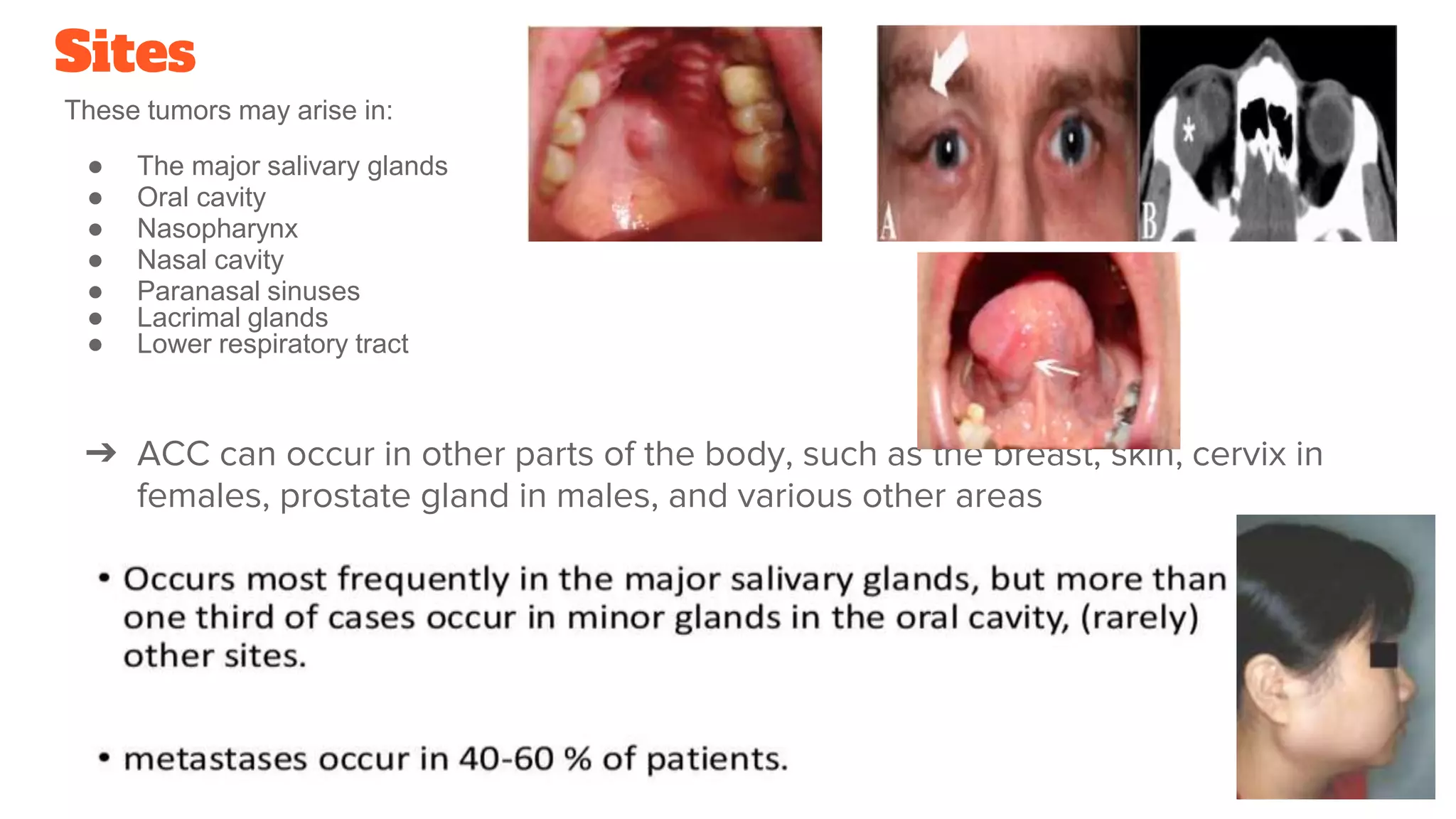 ADENOID CYSTIC CARCINOMA.pptx