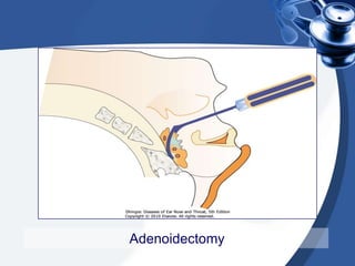 Adenoidectomy | PPTX