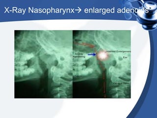 Adenoidectomy | PPTX