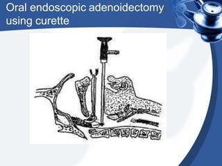 Adenoidectomy 