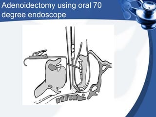 Adenoidectomy 