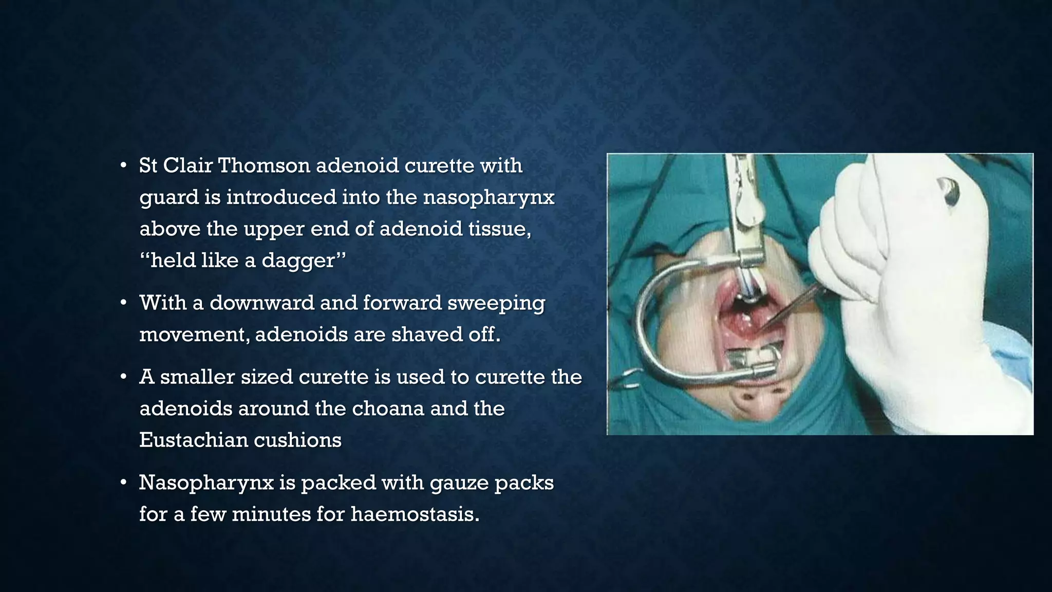 • St Clair Thomson adenoid curette with
guard is introduced into the nasopharynx
above the upper end of adenoid tissue,
“held like a dagger”
• With a downward and forward sweeping
movement, adenoids are shaved off.
• A smaller sized curette is used to curette the
adenoids around the choana and the
Eustachian cushions
• Nasopharynx is packed with gauze packs
for a few minutes for haemostasis.
 