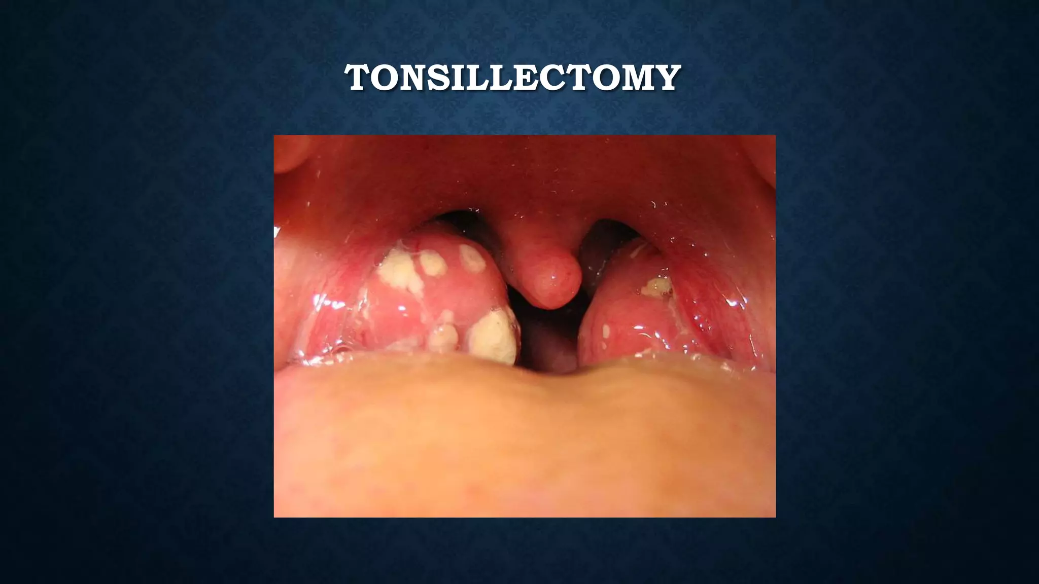 TONSILLECTOMY
 
