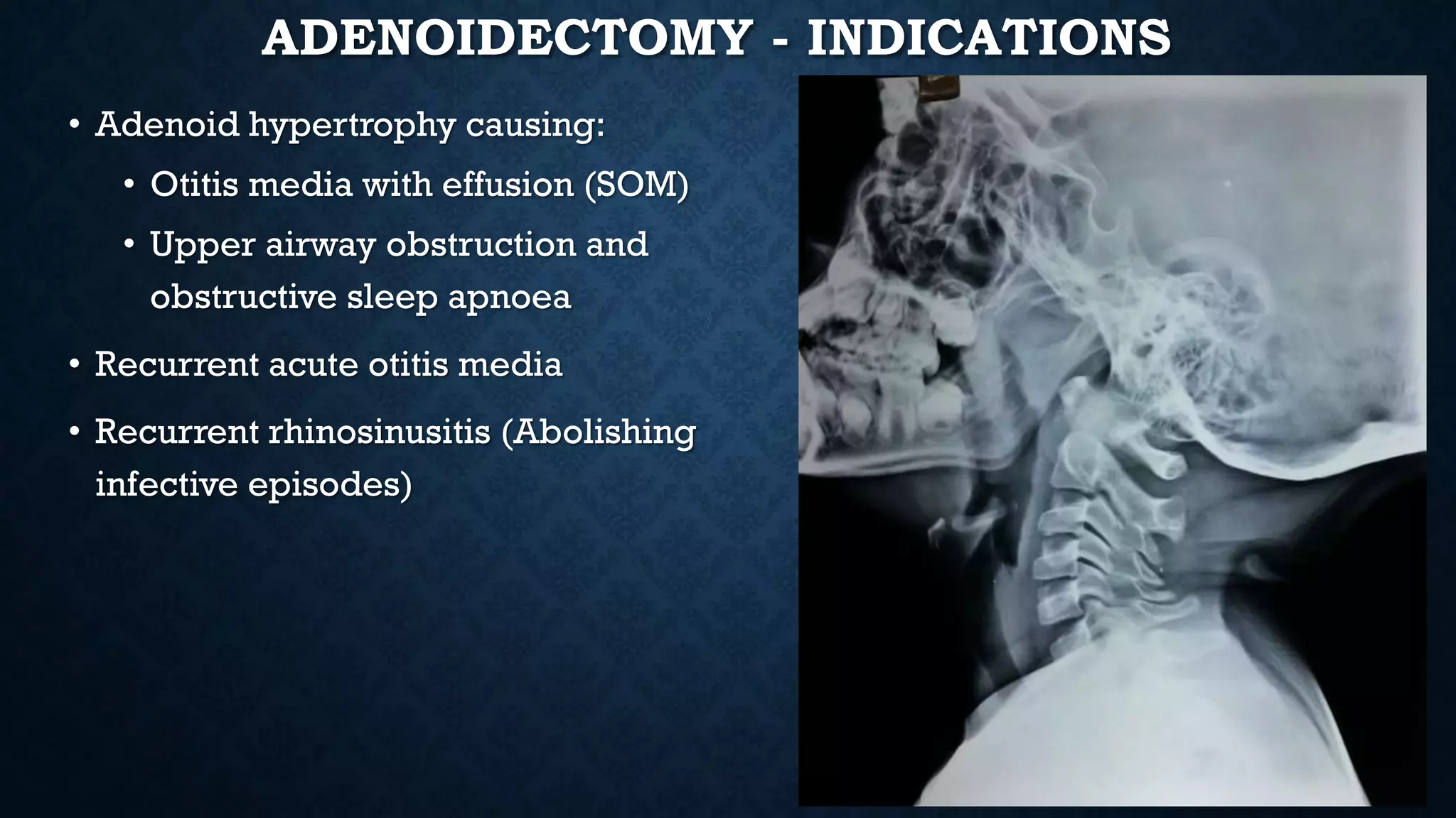 ADENOIDECTOMY - INDICATIONS
• Adenoid hypertrophy causing:
• Otitis media with effusion (SOM)
• Upper airway obstruction and
obstructive sleep apnoea
• Recurrent acute otitis media
• Recurrent rhinosinusitis (Abolishing
infective episodes)
 