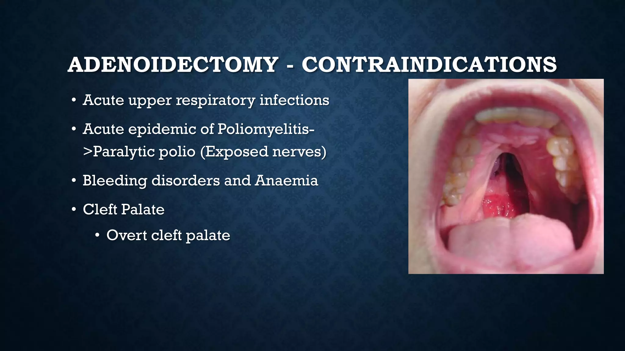 ADENOIDECTOMY - CONTRAINDICATIONS
• Acute upper respiratory infections
• Acute epidemic of Poliomyelitis-
>Paralytic polio (Exposed nerves)
• Bleeding disorders and Anaemia
• Cleft Palate
• Overt cleft palate
 