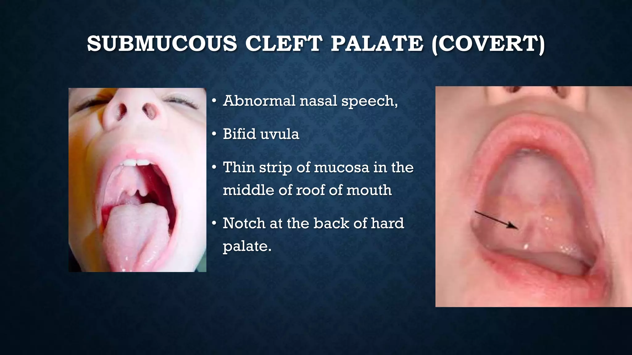 SUBMUCOUS CLEFT PALATE (COVERT)
• Abnormal nasal speech,
• Bifid uvula
• Thin strip of mucosa in the
middle of roof of mouth
• Notch at the back of hard
palate.
 