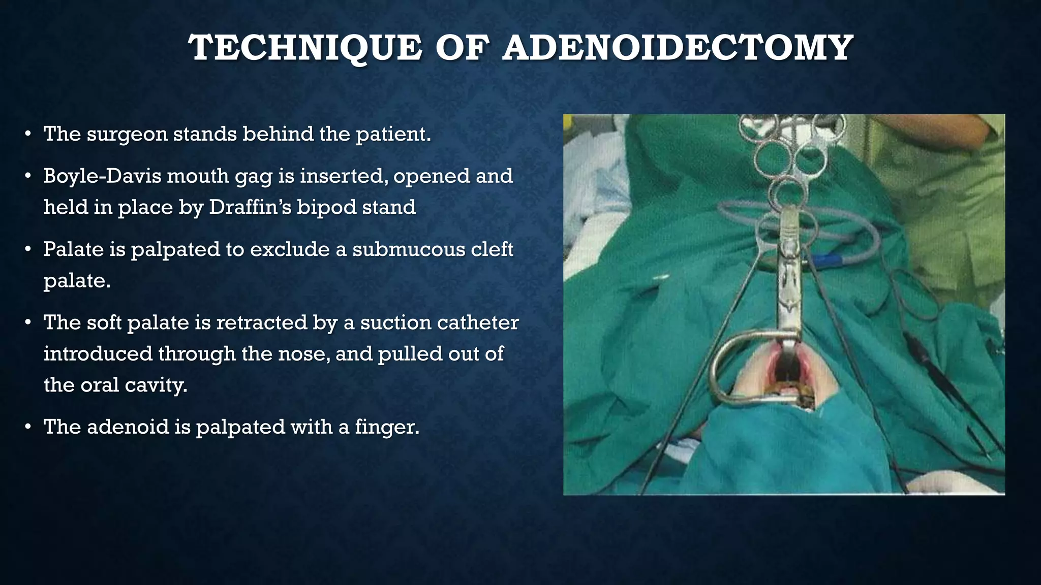 TECHNIQUE OF ADENOIDECTOMY
• The surgeon stands behind the patient.
• Boyle-Davis mouth gag is inserted, opened and
held in place by Draffin’s bipod stand
• Palate is palpated to exclude a submucous cleft
palate.
• The soft palate is retracted by a suction catheter
introduced through the nose, and pulled out of
the oral cavity.
• The adenoid is palpated with a finger.
 