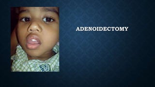 How To Pronounce Adenectomy _ Adenectomy Pronunciation Online – HUHYG