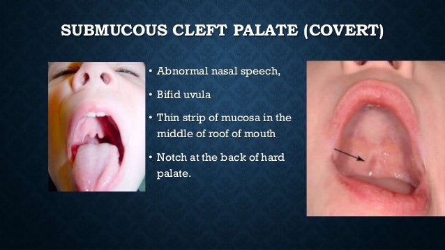 adenoidectomy and tonsillectomy