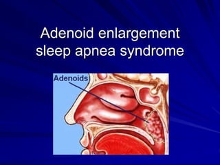 Adenoid enlargement
sleep apnea syndrome
 