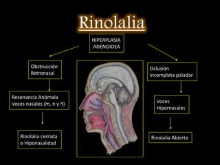DxEx. Cavidad oral y faringéa.Rinoscopia posterior.Rinofibrolaringoscopia simple . Rxde cavum o Rxlateral de garganta.PolisomnografíaTAC