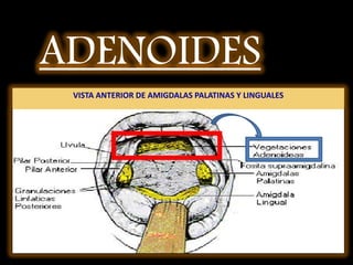 ADENOIDES,[object Object],VISTA ANTERIOR DE AMIGDALAS PALATINAS Y LINGUALES,[object Object]