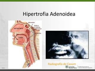 Hipertrofia AdenoideaRadiografía de Cavum