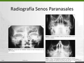 Radiografía Senos Paranasales