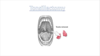Adenoiditis - easy explanation for nursing students