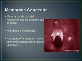 • Es una banda de tejido
  conectivo que se extiende sobre
  la glotis.

• Completa o incompleta.

• Una pequeña membrana puede
  provocar disnea, llanto débil o
  disfonico.
 