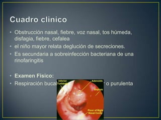 • Obstrucción nasal, fiebre, voz nasal, tos húmeda,
  disfagia, fiebre, cefalea
• el niño mayor relata deglución de secreciones.
• Es secundaria a sobreinfección bacteriana de una
  rinofaringitis

• Examen Físico:
• Respiración bucal, descarga posterior o purulenta
 