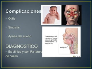 • Otitis

• Sinusitis

• Apnea del sueño


DIAGNOSTICO
• Es clinico y con Rx lateral
de cuello.
 